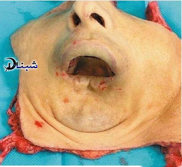 پیوند صورت و تصاویر جالب مرد جوان بعد از پیوند چهره