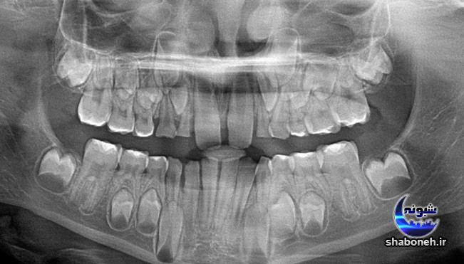 راه حل رویش دندان دائمی کودکان پشت دندان شیری