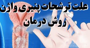 ترشحات پنیری واژن