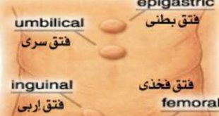 انواع فتق و علائم و راه تشخیص فتق + نکات مهم بعد از جراحی