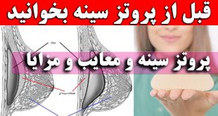 پروتز سینه و معایب و مزایای پروتز سینه