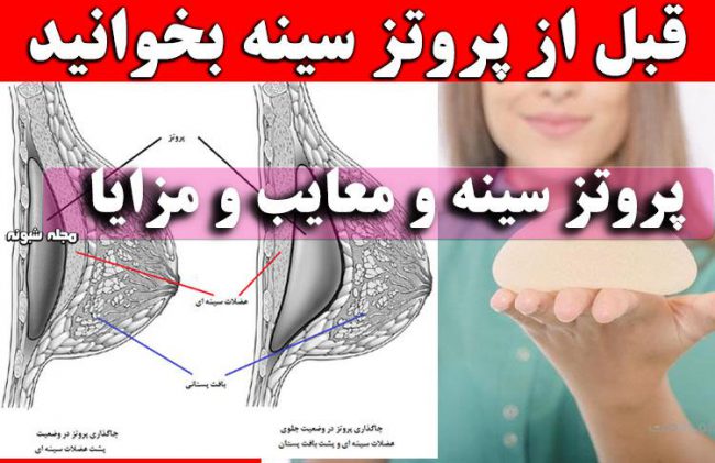 پروتز سینه و معایب و مزایای پروتز سینه + قبل از پروتز سینه بخوانید