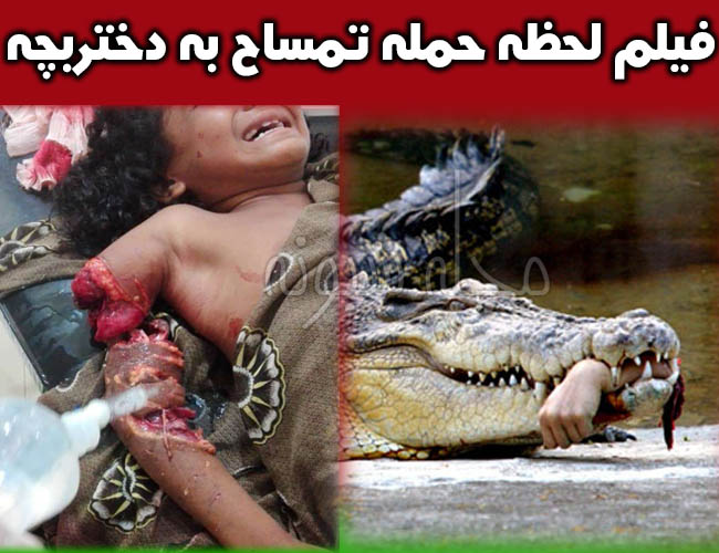 حمله تمساح به کودک در شهر سرباز +عکس قطع دست دختربچه توسط تمساح گاندو