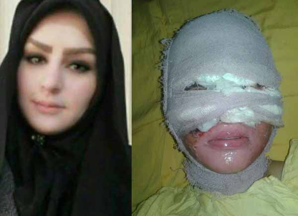 بیوگرافی تهمینه یوسفی قربانی اسیدپاشی پدر و برادرش + اینستاگرام
