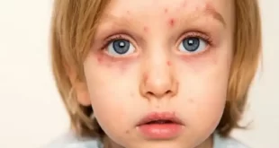 مراکز تزریق واکسن سرخک برای کودکان و بزرگسالان در تهران و شهرستانها