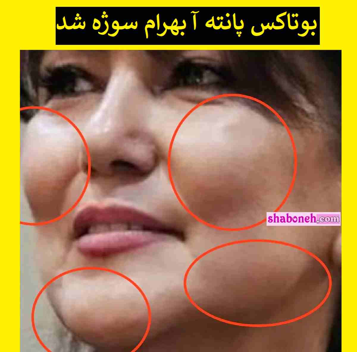 بوتاکس پانته آ بهرام سوژه شد خانم بازیگر شبیه دختر 20 ساله شده است
