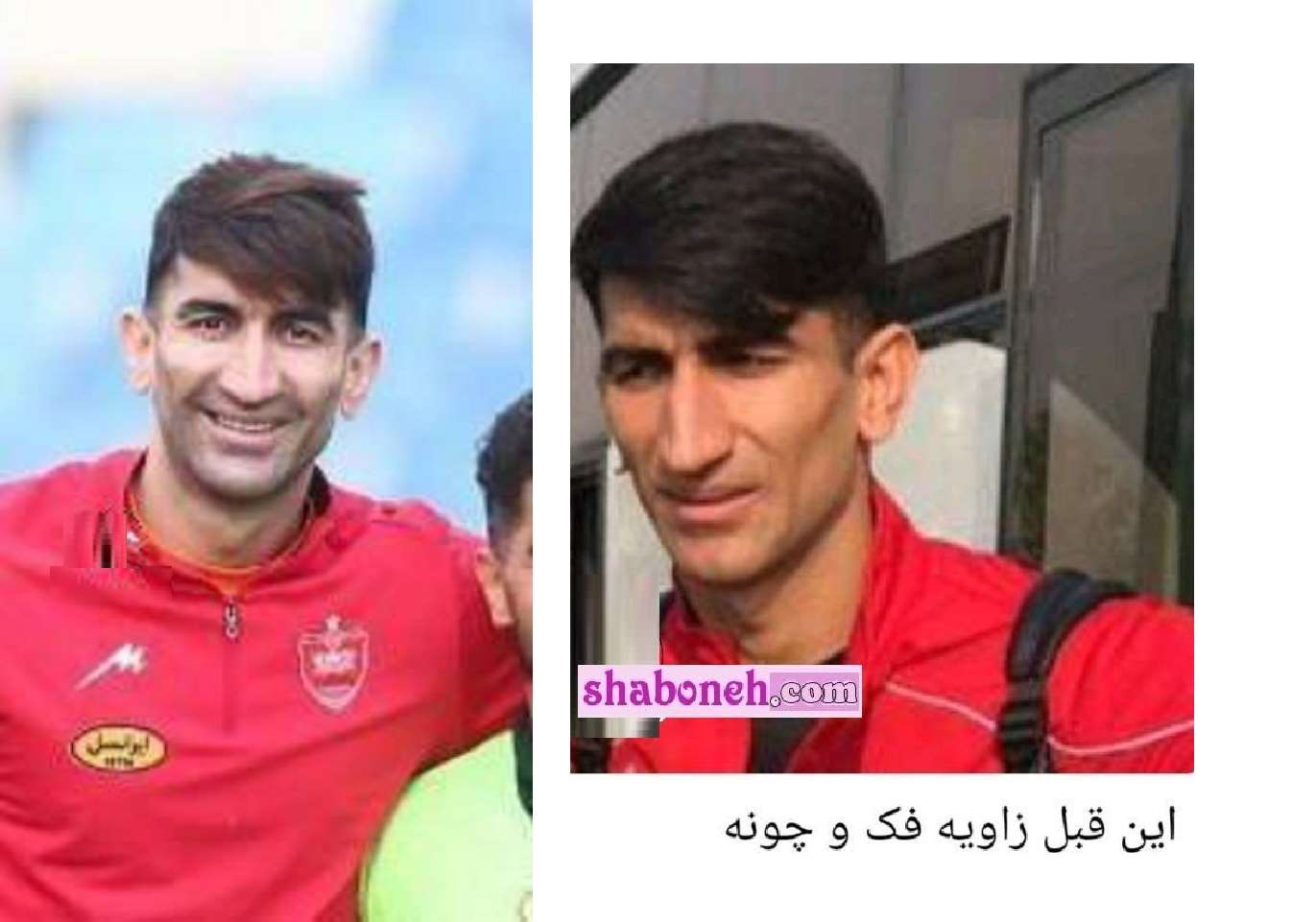 عمل جراحی زیبایی زاویه فک و چونه علیرضا بیرانوند و تزریق ژل