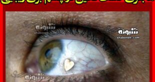ماجرای کاشت نگین در چشم برای زیبایی +تصاویر و تعرفه قیمت ها