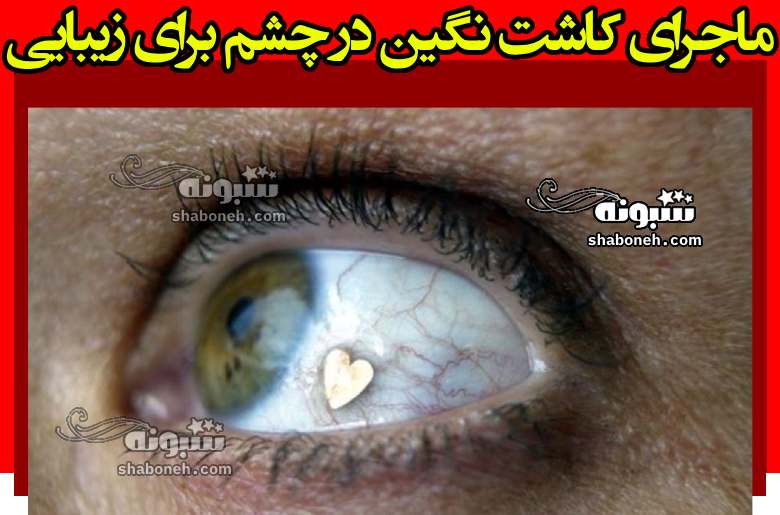 ماجرای کاشت نگین در چشم برای زیبایی +تصاویر و تعرفه قیمت ها