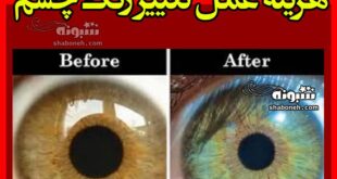 هزینه عمل تغییر رنگ چشم از 300 میلیون تا 700 میلیون تومان