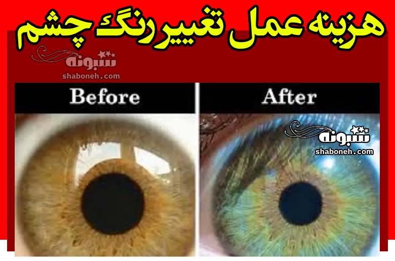 هزینه عمل تغییر رنگ چشم از 300 میلیون تا 700 میلیون تومان