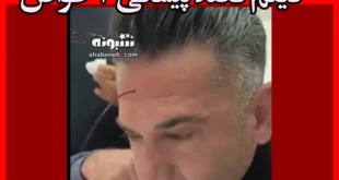 فصد پیشانی چیست + خواص و فواید و فیلم (18+)