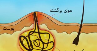 کیست مویی دنبالچهکیست مویی یکی از بیماری‌های ناحیه نشیمنگاهی به شمار می‌رود که در شکاف بین دو باسن و در انتهای استخوان دنبالچه در زیر پوست به وجود می‌آید. این بیماری به شکل یک توده متورم است و با علائم خاصی همراه است که باعث می‌شود بیمار برای تشخیص آن به پزشک مراجعه کند. از جمله علائمی که باعث می‌شوند فرد جهت درمان کیست مویی به پزشک متخصص مراجعه کند موارد زیر هستند: احساس درد در ناحیه بالای باسن قرمز و دردناک شدن ناحیه اطراف کیست مویی ترشح خونی یا چرک در صورت پاره شدن آبسه کیست مویی وجود یک یا چند سوراخ در پوست ناحیه دچار عارضه بیرون‌زدن موها از ضایعه این علائم نشان‌دهنده عارضه کیست مویی هستند و زمانی که فرد جهت تشخیص کیست مویی به پزشک مراجعه می‌کند با بررسی این علائم تشخیص بیماری امکان‌پذیر می‌شود. تشخیص کیست مویی با شنیدن وضعیت علائم بیمار و سپس معاینه فیزیکی صورت می‌گیرد. در صورتی که عفونت شدید باشد ممکن است پزشک از آزمایش خون جهت تشخیص کیست مویی استفاده کند و یا نیاز ببیند که تصویربرداری از محل کیست انجام شود. برای تشخیص بیماری کیست مویی حتماً باید به متخصصان کولورکتال مراجعه شود. این پزشکان تخصص خود را در زمینه بیماری‌های ناحیه روده بزرگ و مقعد به دست آورده‌اند و همین مسئله کمک می‌کند تا بتوانند به بهترین شکل بیماری کیست مویی را تشخیص دهند و سپس برای درمان آن اقدام نمایند. کیست مویی دنبالچه چیست؟ شاید برای بسیاری از افراد سؤال باشد که کیست مویی دنبالچه چیست؟ در جواب این سؤال که کیست مویی دنبالچه چیست؟ باید گفت این کیست در واقع همان کیست مویی ناحیه مقعدی یا سینوس پیلونیدال است. کیست مویی دنبالچه بر اثر بازگشت مو به زیر پوست شکاف میان دو باسن به وجود می‌آید و با چرک و عفونت در ناحیه نیز همراه است. این بیماری در مردان شایع‌تر است اما می‌تواند در زنان نیز دیده شود. کیست مویی دنبالچه زمانی که دچار عفونت شود به نام آبسه پیلونیدال نیز شناخته می‌شود. در این وضعیت کیست بسیار دردناک است و می‌تواند با درد و مشکلات ناشی از خود فعالیت‌های روزمره فرد را نیز دچار مشکل کند. کیست مویی دنبالچه به دلایل مختلفی در بدن به وجود می‌آید که از جمله آنها می‌توان به موارد زیر اشاره کرد: عوامل ژنتیکی نشستن بیش از حد پوشیدن لباس‌های تنگ با ایجاد اصطکاک در ناحیه شکاف دو باسن داشتن موهای زائد بیش از حد در ناحیه شکاف دو باسن اضافه وزن تحرک بسیار کم عواملی که از آنها نام برده شد نقش مهمی در ابتلا فرد به کیست مویی دارند. کیست مویی نیازمند درمان است؛ زیرا عدم درمان آن می‌تواند باعث مشکلاتی همچون عود کیست، عفونت سیستمیک و یا سرطان پوست در موارد بسیار نادر شود. درمان این بیماری فقط از طریق جراحی یا لیزر کیست مویی امکان‌پذیر است و هیچ درمان دارویی یا درمان خانگی نمی‌تواند این بیماری را مداوا بکند. بسیار مهم است افراد از خوددرمانی با روش‌های متفاوت خودداری کنند و درمان کیست مویی خود را به فوق‌تخصصان ناحیه روده بزرگ و مقعد بسپارند. لیزر کیست مویی درمان فوری کیست مویی با لیزر چگونه انجام می‌شود؟ یکی از روش‌های مداوای سینوس پیلونیدال درمان این بیماری با لیزر است. درمان فوری کیست موی با لیزر یکی از روش‌هایی است که امروزه از طرف پزشکان بسیار پیشنهاد می‌شود و محبوبیت بالایی دارد. درمان فوری کیست مویی با لیزر امروزه در مراکز درمانی مختلفی انجام می‌شود و می‌تواند این بیماری را در کمتر از ۳۰ دقیقه برای همیشه درمان کند. درمان فوری کیست مویی با لیزر یک روش کم تهاجمی است که نیازی به بیهوشی و بستری شبانه ندارد. همچنین به دلیل اینکه بدون درد و خونریزی است نیازی به طی کردن دوران نقاهت ایجاد نمی‌کند و فرد می‌تواند به راحتی پس از انجام آن امور روزمره خود را از سر گیرد. درمان فوری کیست مویی با لیزر امروزه جایگزین روش جراحی شده است و در مراکز درمانی بسیاری از این روش برای درمان استفاده می‌کنند. یکی از این مراکز تخصصی مرکز درمان فوری است که در آن فوق‌تخصصان کولورکتال به درمان این بیماری می‌پردازند. تخصص بالای پزشکان این مجموعه کمک می‌کند تا کیست مویی برای همیشه در این مرکز درمانی مداوا شود. دستگاه‌های لیزر مجهز و به روز این مجموعه نیز کمک می‌کنند تا عوارض ناخوشایندی همچون ایجاد گوشت اضافه در ناحیه مقعد و به دنبال آن تنگی مقعد و بی‌اختیاری گاز معده و کنترل مدفوع باعث مشکلات برای فرد پس از درمان نشوند. هزینه لیزر کیست مویی هزینه عمل کیست مویی چقدر است؟ اینکه برای بسیاری از بیماران مبتلا به عارضه سینوس پیلونیدال سؤال باشد که هزینه عمل کیست مویی چقدر است؟ بسیار طبیعی است؛ زیرا آگاهی از این مسئله به بیماران کمک می‌کند تا هزینه‌های خود را در روند درمان بهتر مدیریت کنند. در جواب این سؤال که هزینه عمل کیست مویی چقدر است؟ باید گفت هزینه این عمل به موارد مختلفی بستگی دارد که در ادامه آنها را شرح می‌دهیم: نوع عمل کیست مویی به دو روش جراحی و لیزردرمانی مداوا می‌شود. روش جراحی به وسیله تیغ جراحی به دو شکل باز و بسته صورت می‌گیرد. انجام این روش به دلیل نیاز به بیهوشی و مراقبت‌های دیگر، در بیمارستان باید انجام شود و هزینه‌های بیمارستانی به هزینه‌های دیگر درمان اضافه می‌شوند. لیزردرمانی کیست مویی در مراکز درمانی انجام می‌گیرد و به همین دلیل هزینه‌های بیمارستانی شامل آن نمی‌شود و همین مسئله کمک می‌کند به نسبت جراحی هزینه آن پایین‌تر باشد. تخصص و تجربه پزشک در جواب اینکه هزینه عمل کیست مویی چقدر است؟ همچنین باید به تخصص و تجربه پزشک اشاره کرد. پزشکان فوق‌تخصص که در زمینه بیماری‌های روده بزرگ و مقعد دارای تجربه هستند و تبحر بالایی دارند دستمزد بالاتری نیز در مقایسه با پزشکان کم تجربه دریافت می‌کنند. نوع دستگاه‌های لیزر نوع دستگاه لیزر از دیگر مواردی است که بر هزینه عمل کیست مویی تأثیر می‌گذارد. مراکز درمانی که از دستگاه‌های لیزر مجهز و به روز استفاده می‌کنند به دلیل قیمت بالاتر این دستگاه‌ها هزینه بالاتری نیز می‌گیرند. بهداشت مرکز درمانی بهداشت و ایزوله بودن مرکز درمانی از دیگر نکاتی است که می‌تواند بر قیمت عمل کیست مویی اثر بگذارد. هرچه استانداردهای بهداشتی در یک مکان بالاتر باشد هزینه عمل نیز در آن بالاتر است. برای آگاهی از هزینه عمل کیست مویی افراد می‌توانند به مرکز تخصصی درمان فوری مراجعه کنند تا هزینه عمل کیست مویی با لیزر برای آنها تخمین زده شود.