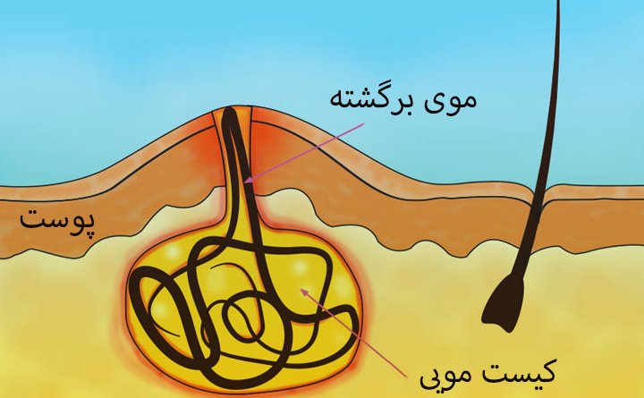 روش تشخیص کیست مویی چگونه است؟